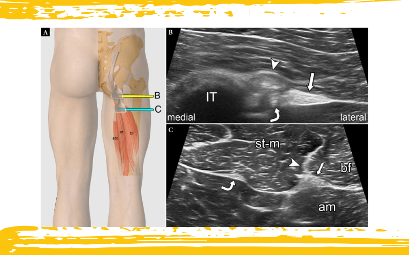3. Compartimento posterior cadera ecografia tempo formacion.png